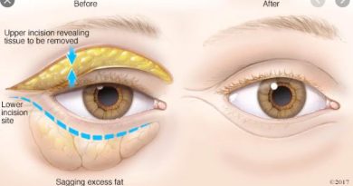 Tips to reduce bags under the eyes