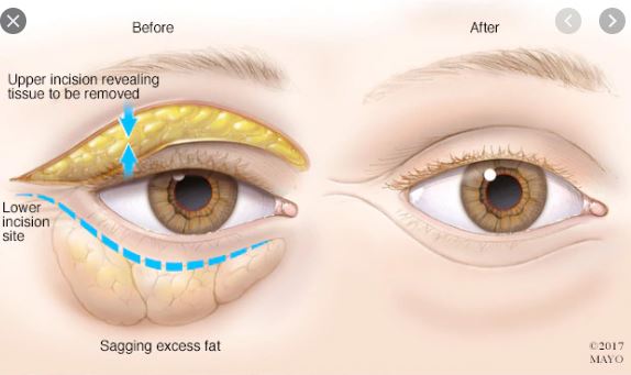 Tips to reduce bags under the eyes