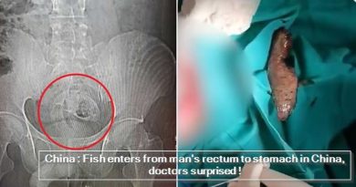 China - Fish enters from man's rectum to stomach in China, doctors surprised !