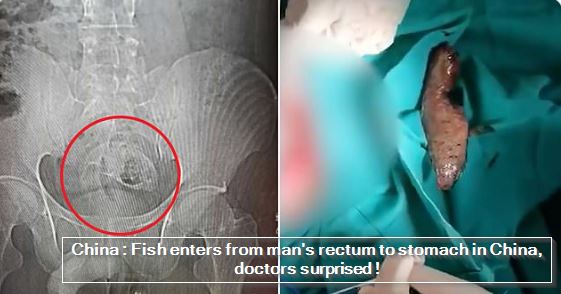 China - Fish enters from man's rectum to stomach in China, doctors surprised !