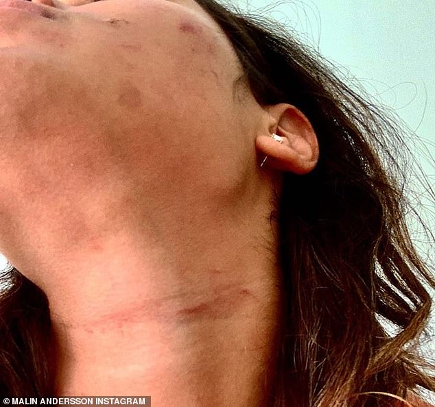 Love Island star Malin Andersson has posted another photo of her domestic abuse injuries after her abusive ex Tom Kemp was jailed