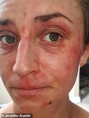 Jennifer Austin (pictured before using the cream), who suffered from eczema so severe it led to panic attacks and her having therapy for anxiety, has praised an £8 natural cream for finally