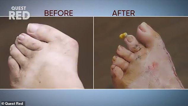 Woman With Crooked Toes Has Them Corrected In Hellish Six Hour Surgery On My Feet Are Killing Me The State