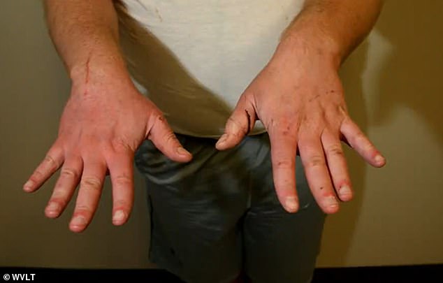 This image shows deep cuts and scratches visible on both his hands at the time of his arrest