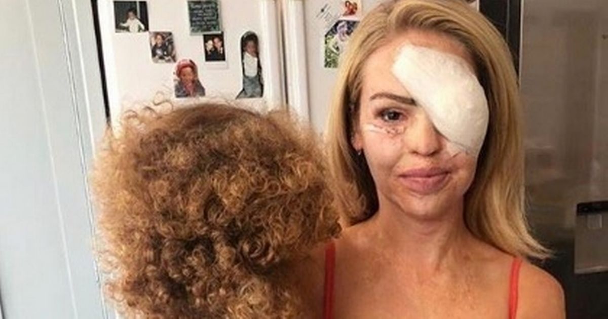 Brave Katie Piper shares harrowing snaps from acid attack for viral challenge