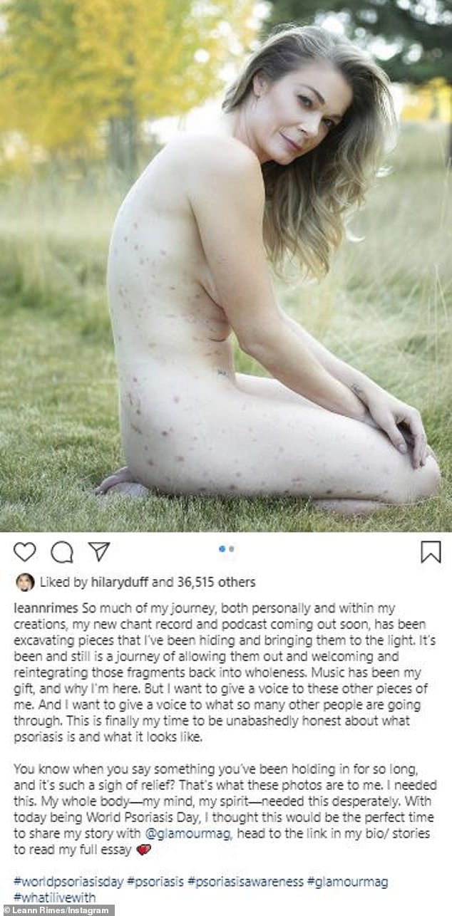 LeAnn Rimes poses NUDE on social media: ‘My time to be unabashedly honest about what psoriasis is’
