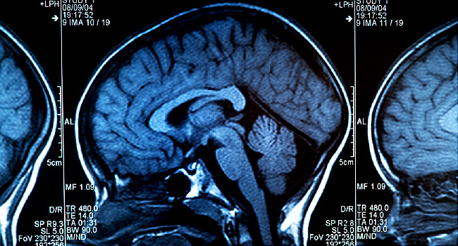 Low Brain Blood Flow May Spur Alzheimer’s Hallmark