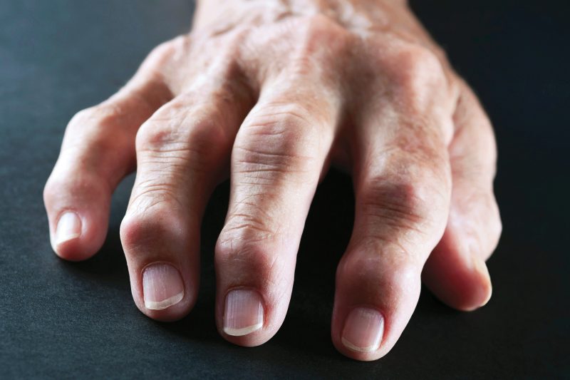 New Rheumatoid Arthritis Drug May Help Tough Cases - The State