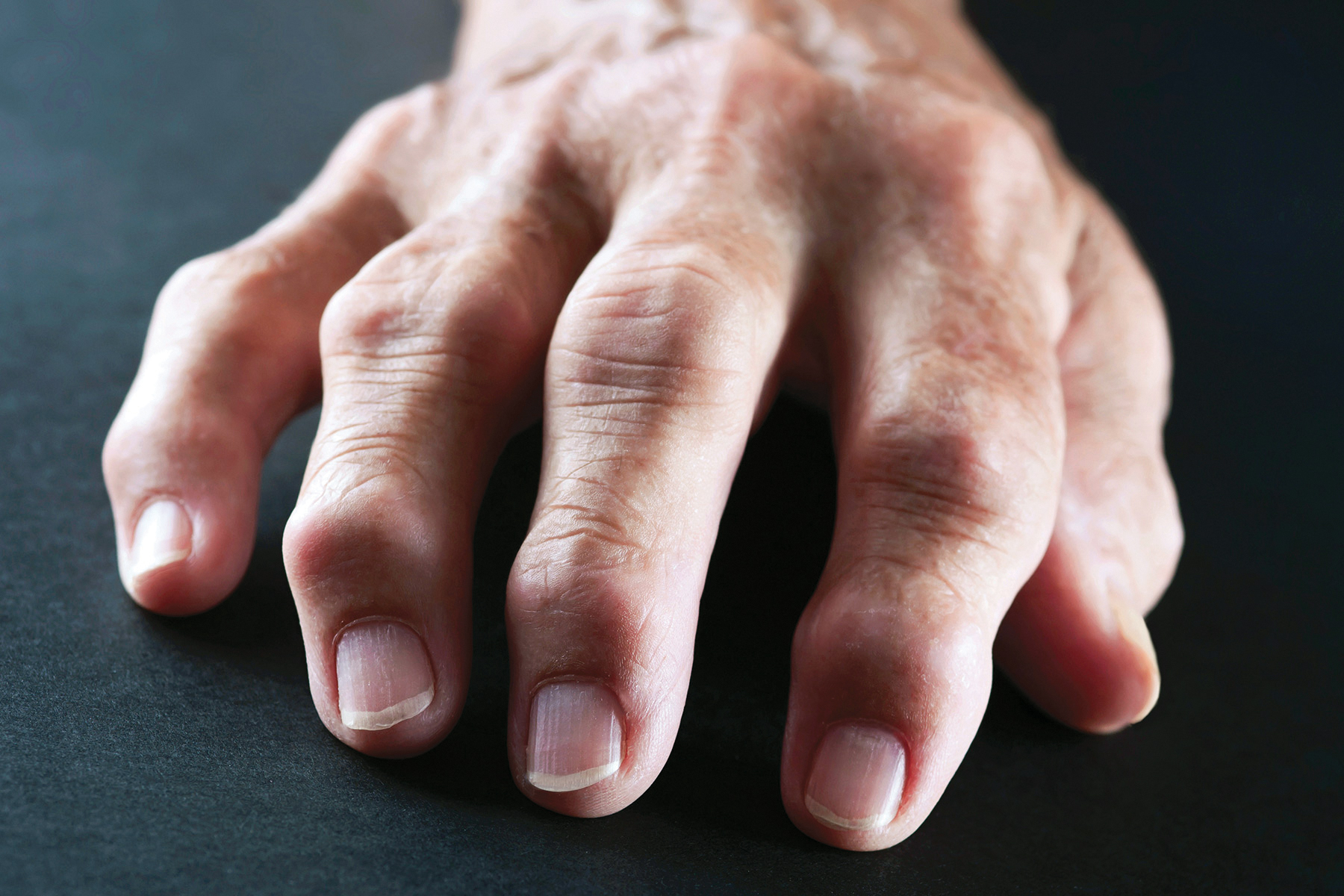 New Rheumatoid Arthritis Drug May Help Tough Cases