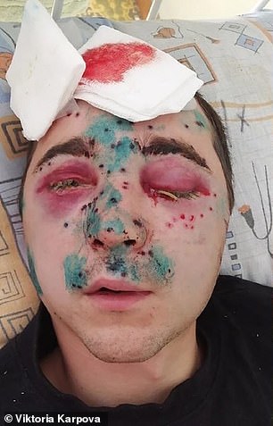 Valery Sosedov, 25, from Kovrov in Russia, is fighting to retain his sight after his friend mistook him for a duck and shot him on a hunting trip