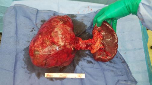 Doctors remove cancerous mass the weight of an average house cat from patient’s pancreas