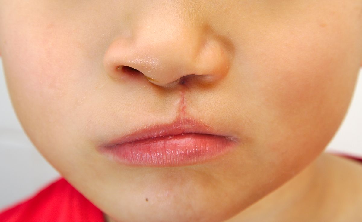 What are the treatments to cure cleft lip | The State