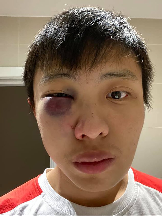 Another youth is said to have begun the confrontation by barging into the student (pictured after the attack) and saying 'coronavirus' in his ear, starting an argument, and punching him twice