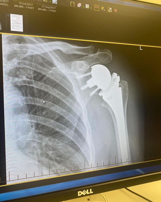 Wayne Lineker shared an X-ray of his shoulder
