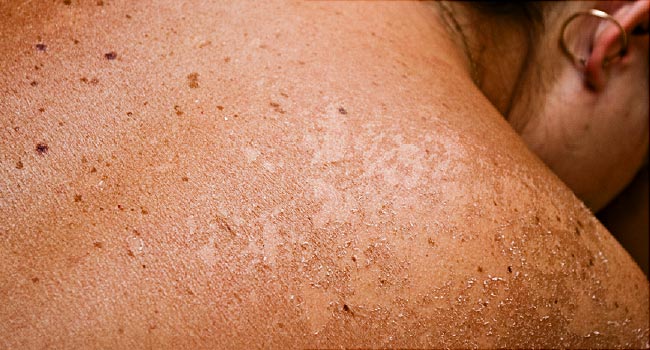 Vaccine May Keep Melanoma in Remission 4 Years