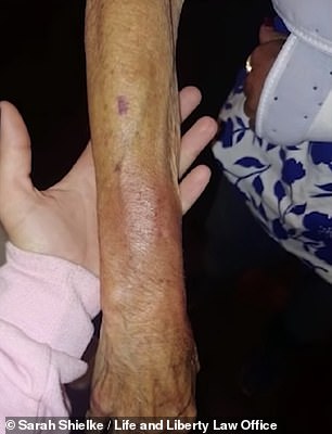 Photos taken in the aftermath of the arrest show Garner with a bruised and swollen arm