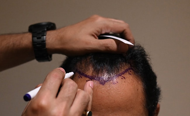 A Sudden Death Leads To Focus On Risky Hair Transplants In India